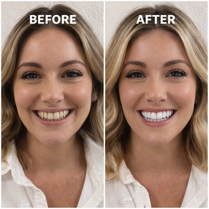 PURPLE WHITENING STRIPS (Gen2)