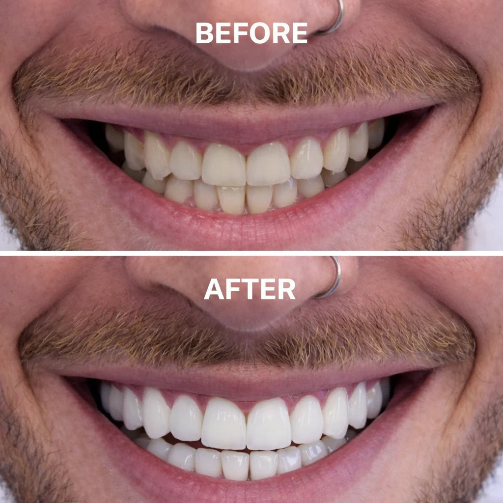 PURPLE WHITENING STRIPS (Gen2)