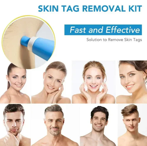 Zavinox 2-in-1 Painless Skin Tag, Mole, and Wart Removal Kit