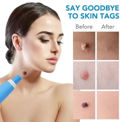 Zavinox 2-in-1 Painless Skin Tag, Mole, and Wart Removal Kit
